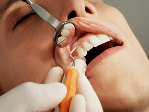 Close-up of a teeth cleaning and dental examination with a dentist checking a patient's teeth with a dental mirror and probe.